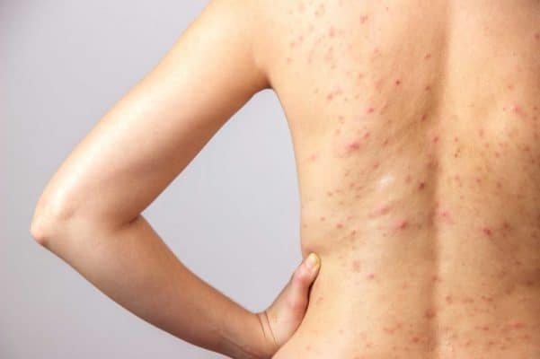 body acne causes